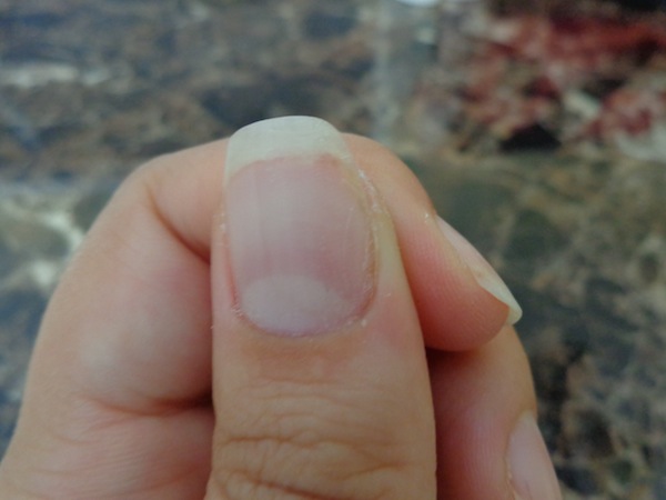 nail with repaired crack